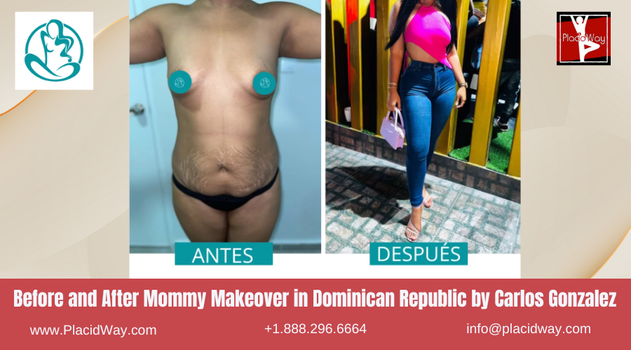 Mommy Makeover in Dominican Republic by Carlos Gonzalez
