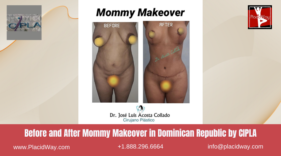 Mommy Makeover in Dominican Republic by CIPLA