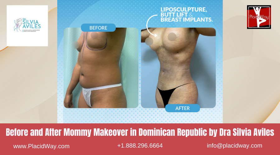 Mommy Makeover in Dominican Republic by Dra Silvia Aviles