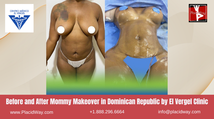 Mommy Makeover in Dominican Republic by El Vergel Clinic