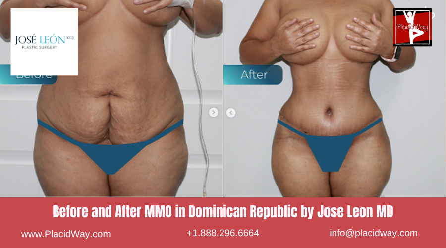 MMO in Dominican Republic by Jose Leon MD