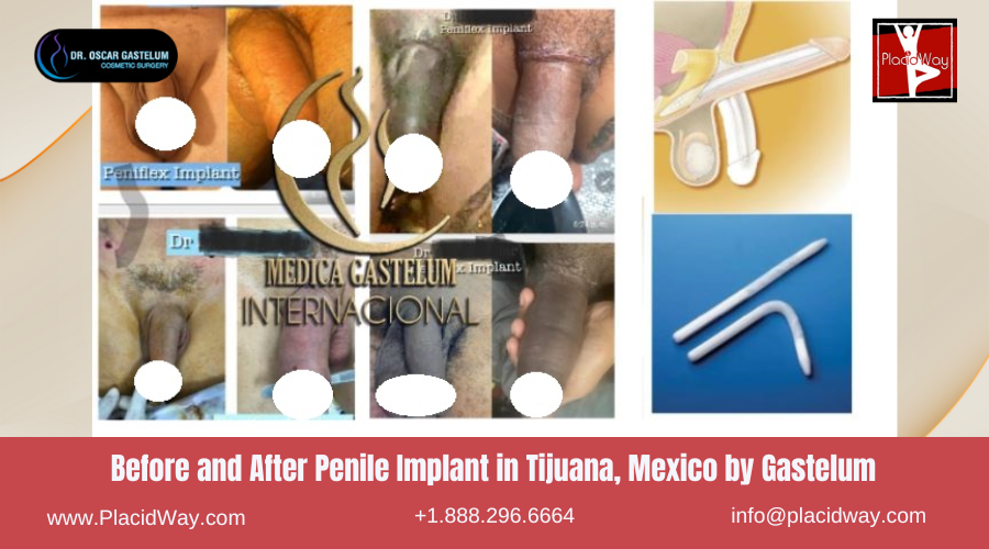 Penile Augmentation in Tijuana Mexico by Gastelum