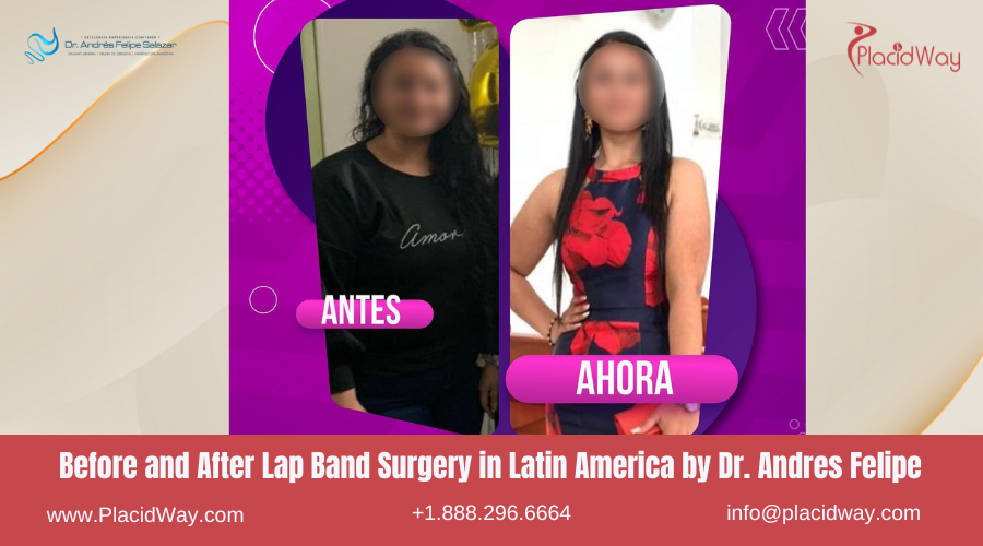 Lap Band Surgery in Latin America Before and After Images - Andres Felipe