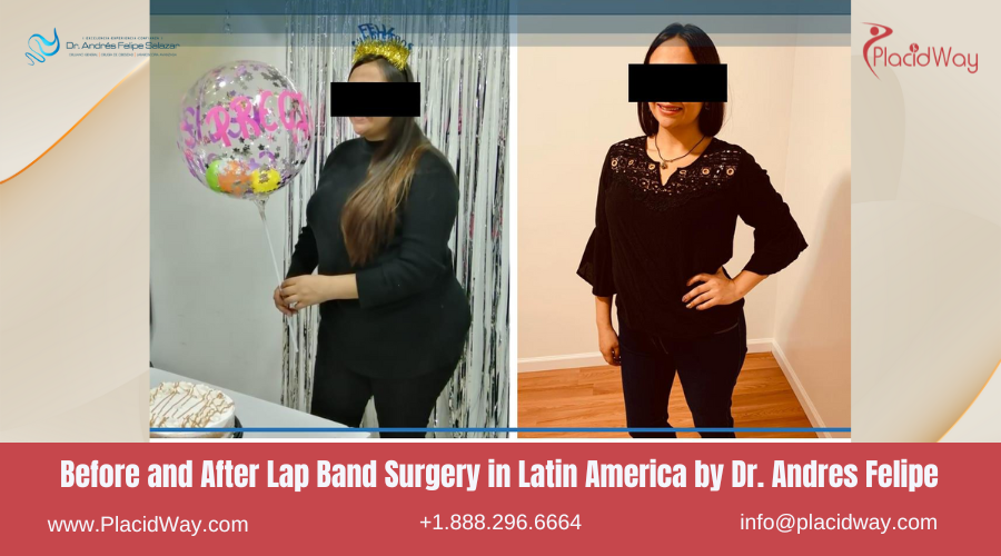 Lap Band Surgery in Latin America Before and After Images - Dr. Andres Felipe