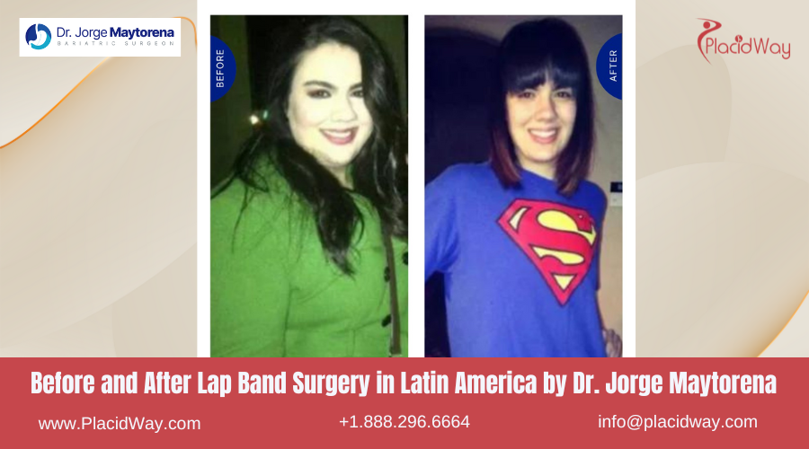 Lap Band Surgery in Latin America Before and After Images - Jorge Maytorena