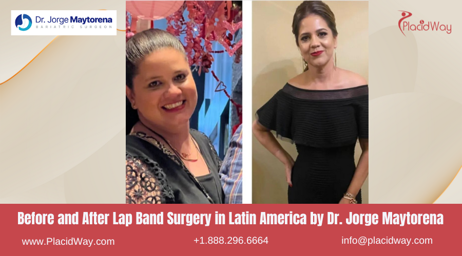 Lap Band Surgery in Larin America Before and After Images - Jorge Maytorena Clinic