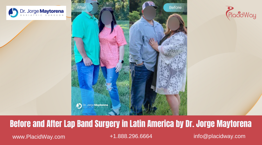 Lap Band Surgery in Latin America Before and After Images - Jorge Maytorena