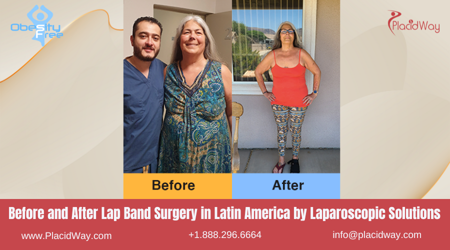 Lap Band Surgery in Latin America Before and After Images - Laparoscopic Solutions