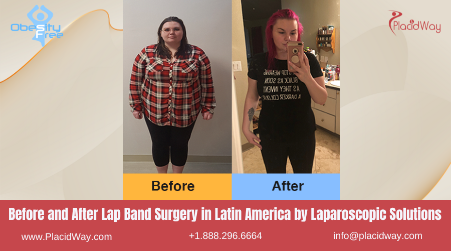 Lap Band Surgery in Latin America Before and After Images - Laparoscopic Solutions Clinic