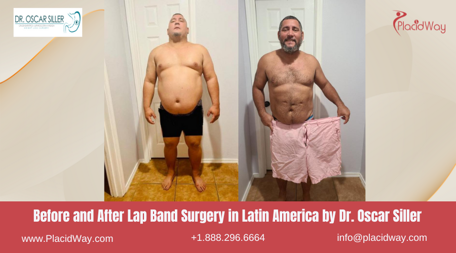 Lap Band Surgery in Latin America Before and After Images - Oscar Siller