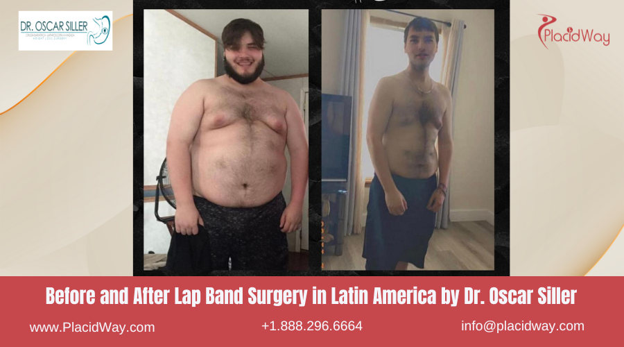 Lap Band Surgery in Latin America Before and After Images - Oscar Siller