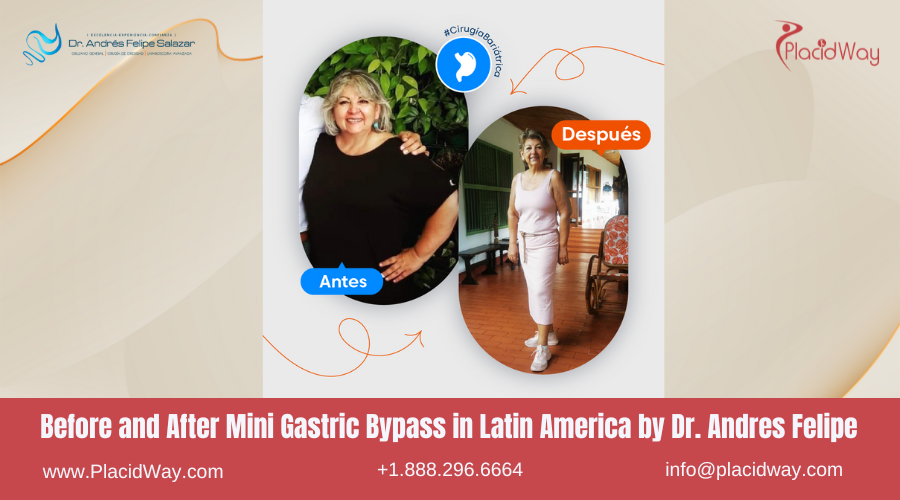 Mini Gastric Bypass in Latin America Before and After Images - Andres Felipe