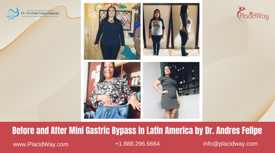 Mini Gastric Bypass in Latin America Before and After Images - Andres Felipe