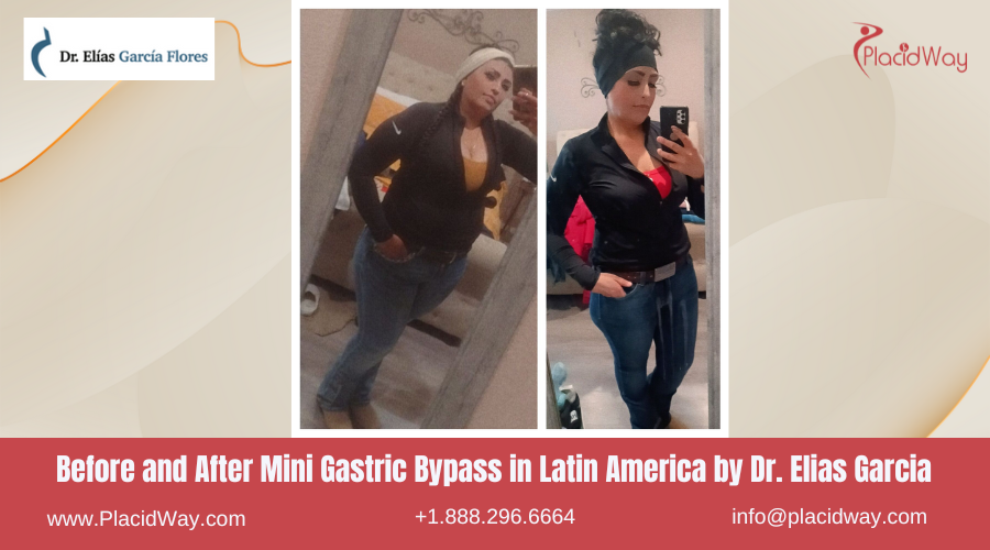 Mini Gastric Bypass in Latin America Before and After Images - Dr Elias Garcia