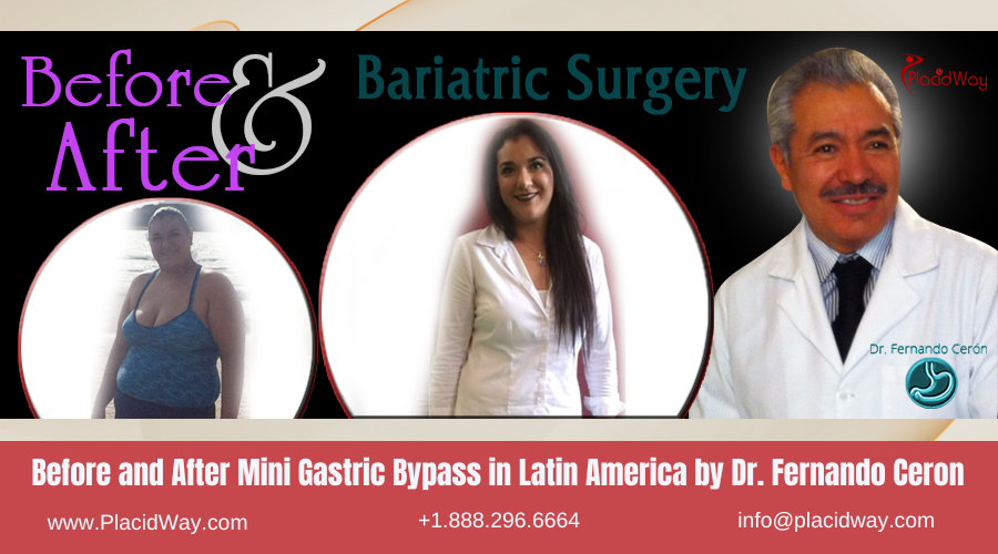 Mini Gastric Bypass in Latin America Before and After Images - Dr Fernando Ceron