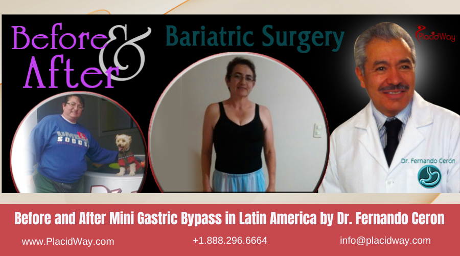 Mini Gastric Bypass in Latin America Before and After Images - Fernando Ceron