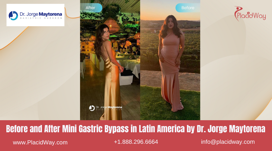 Mini Gastric Bypass in Latin America Before and After Images - Jorge Maytorena