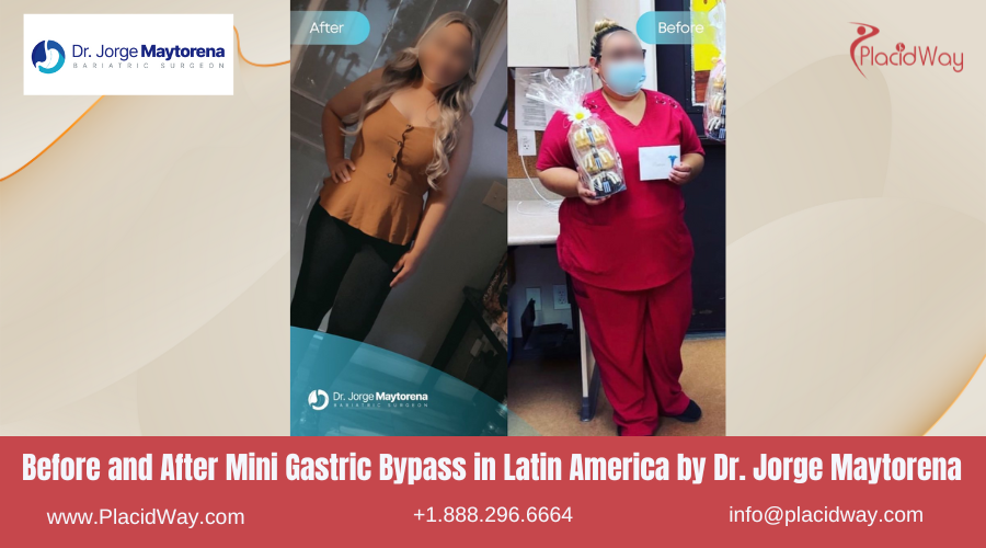 Mini Gastric Bypass in Latin America Before and After Images - Dr. Jorge Maytorena