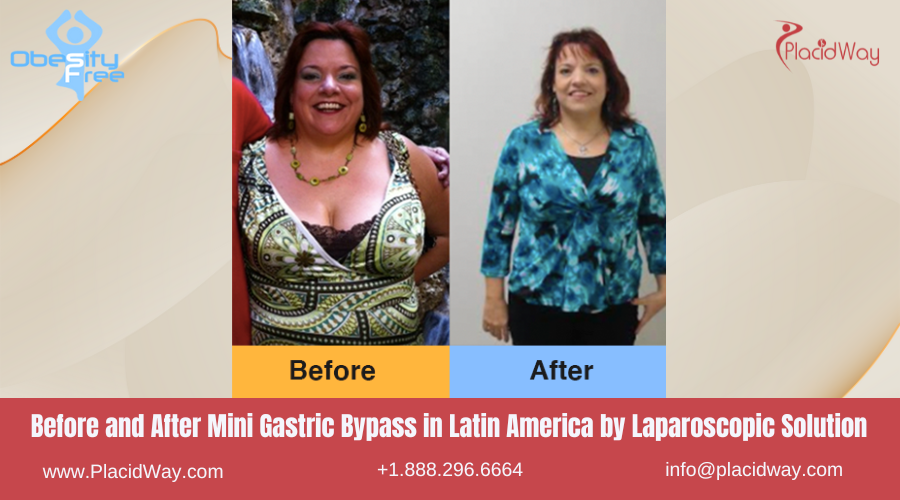 Mini Gastric Bypass in Latin America Before and After Images - Laparoscopic Solutions
