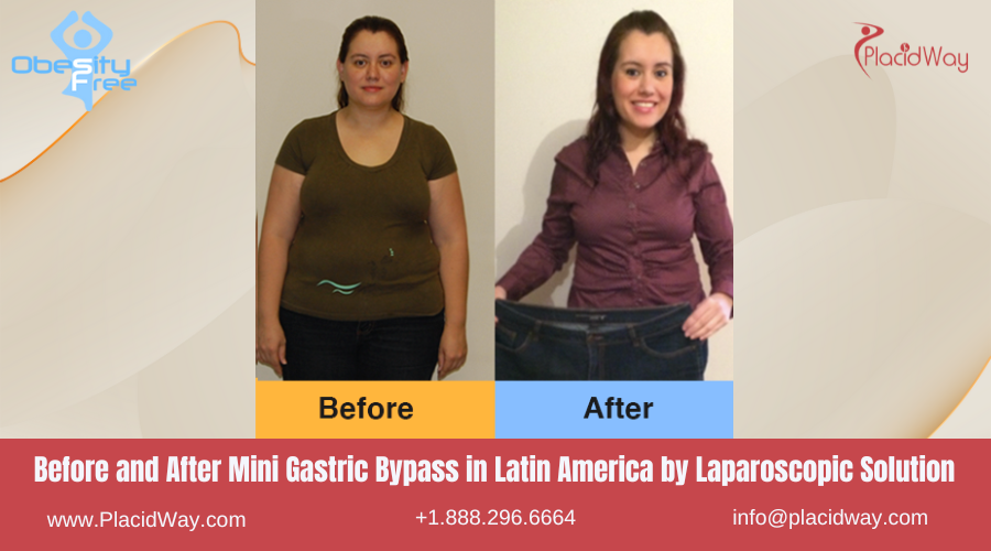 Mini Gastric Bypass in Latin America Before and After Images - Laparoscopic Solutions Clinic