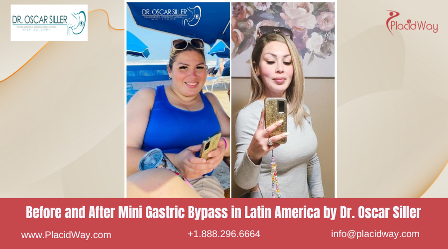 Mini Gastric Bypass in Larin America Before and After Images - Oscar Siller