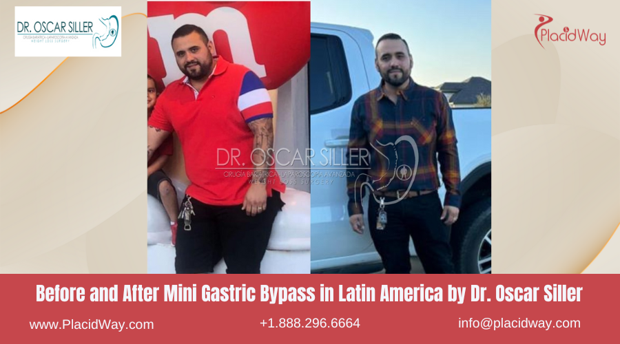 Mini Gastric Bypass in Larin America Before and After Images - Dr. Oscar Siller