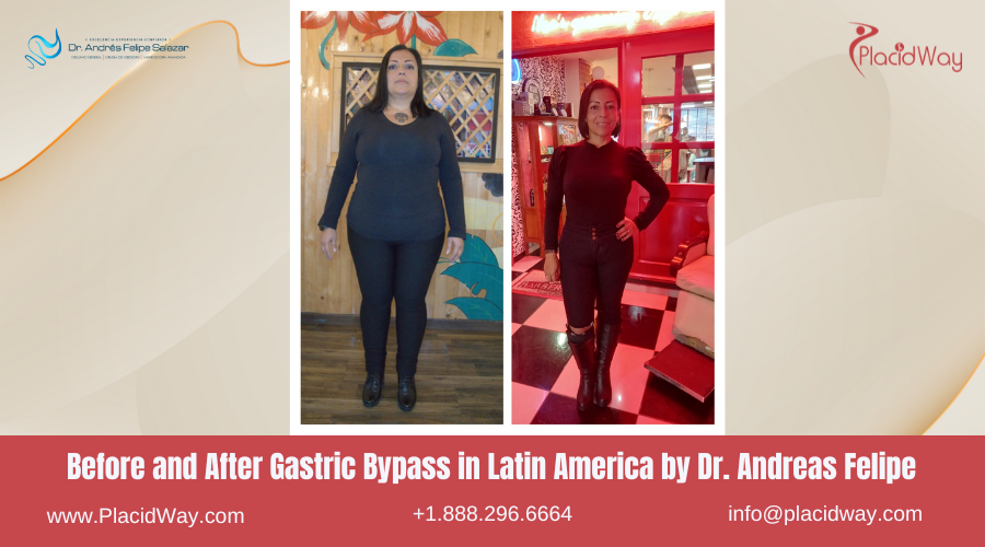 Gastric Bypass in Latin America Before and After Images - Andreas Felipe