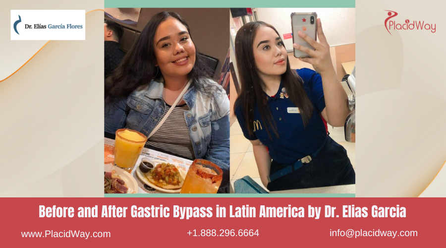 Gastric Bypass in Latin America Before and After Images - Elias Garcia