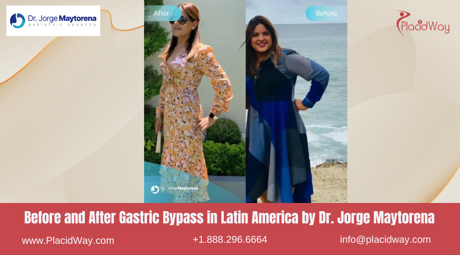 Gastric Bypass in Latin America Before and After Images - Jorge Maytorena