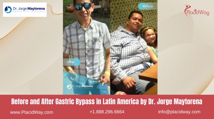 Gastric Bypass in Latin America Before and After Images - Dr. Jorge Maytorena