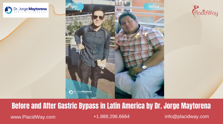 Gastric Bypass in Latin America Before and After Images - Jorge Maytorena Clinic