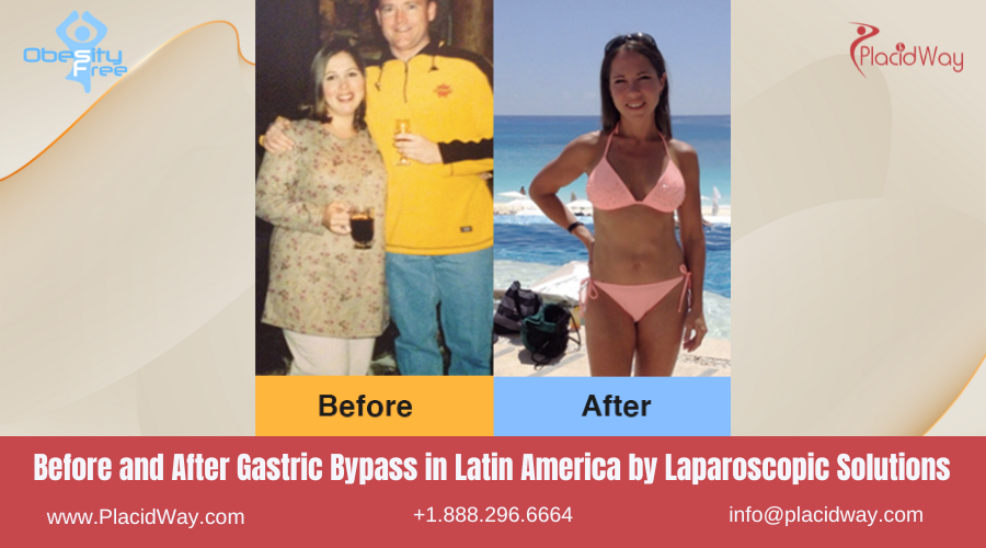 Gastric Bypass in Latin America Before and After Images - Laparoscopic Solutions