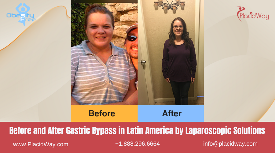 Gastric Bypass in Latin America Before and After Images - Laparoscopic Solutions