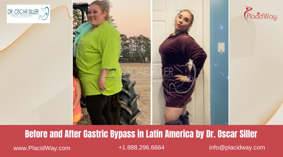 Gastric Bypass in Latin America Before and After Images - Oscar Siller
