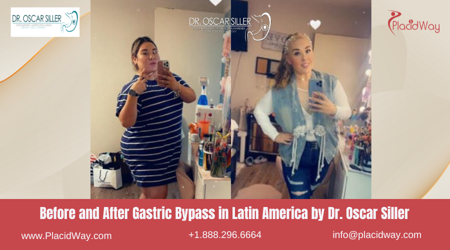 Gastric Bypass in Latin America Before and After Images - Dr. Oscar Siller