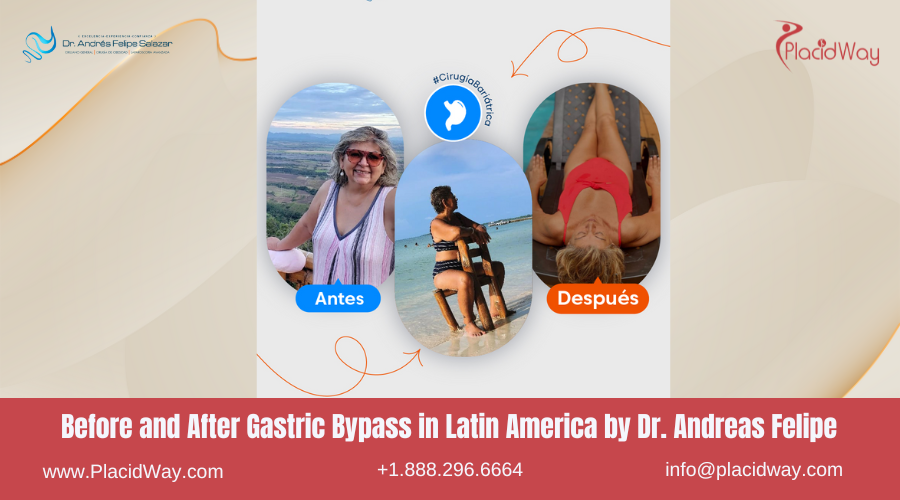 Gastric Bypass in Latin America Before and After Images - Oscar Siller Clinic