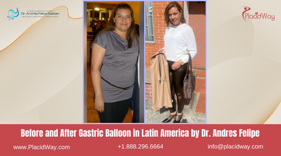 Gastric Balloon in Latin America Before and After Images - Dr Andres Felipe