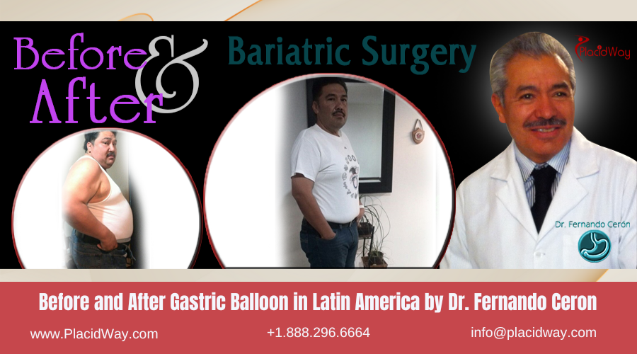 Gastric Balloon in Latin America Before and After Images - Dr Fernando Ceron