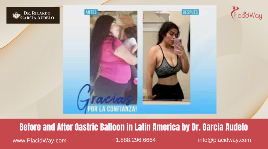 Gastric Balloon in Latin America Before and After Images - Dr Garcia Audelo