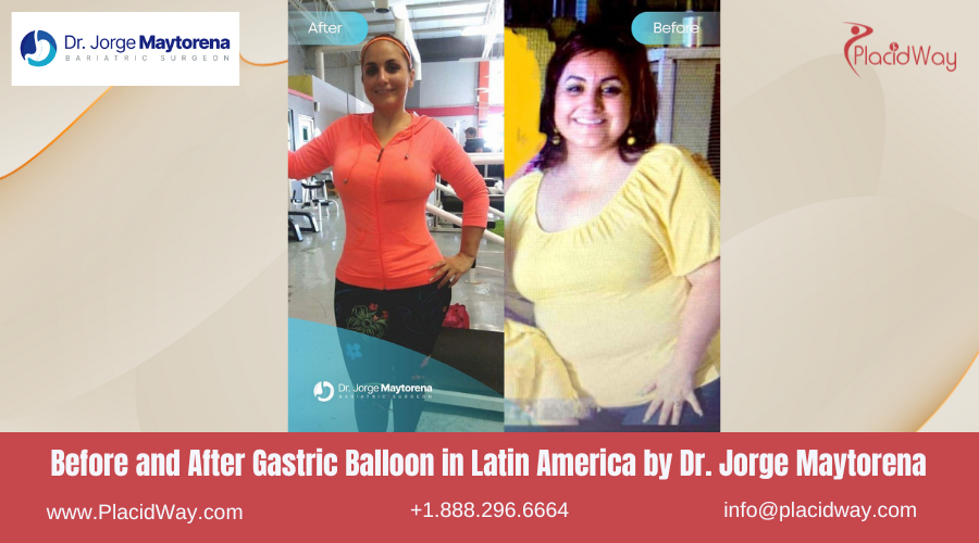 Gastric Balloon in Latin America Before and After Images - Dr Jorge Maytorena
