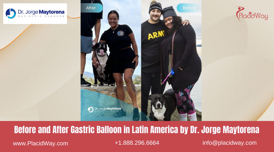 Gastric Balloon in Latin America Before and After Images - Jorge Maytorena