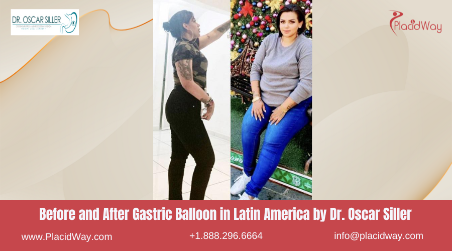 Gastric Balloon in Latin America Before and After Images - Dr Oscar Siller