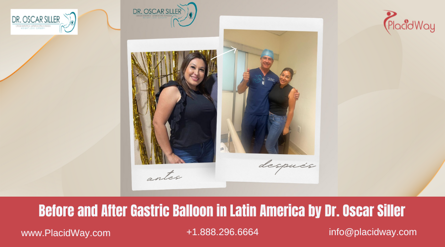 Gastric Balloon in Latin America Before and After Images - Oscar Siller
