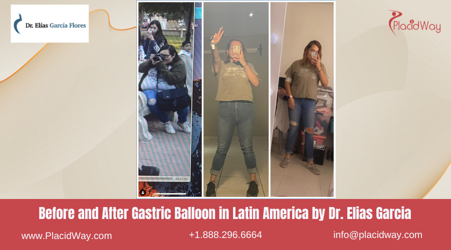 Gastric Balloon in Latin America Before and After Images - Dr. Elias Garcia