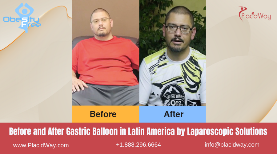 Gastric Balloon in Latin America Before and After Images - Laparoscopic Solution