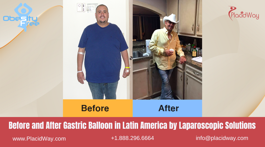 Gastric Balloon in Latin America Before and After Images - Laparoscopic Solution