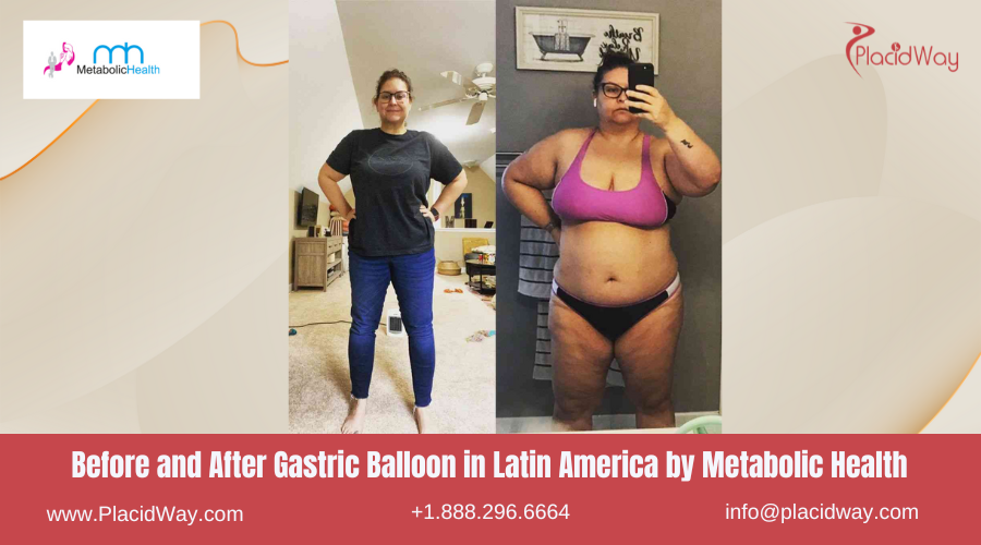 Gastric Balloon in Latin America Before and After Images - Metabolic Health
