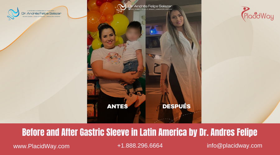 Gastric Sleeve in Latin America Before and After Images - Dr Andres Felipe