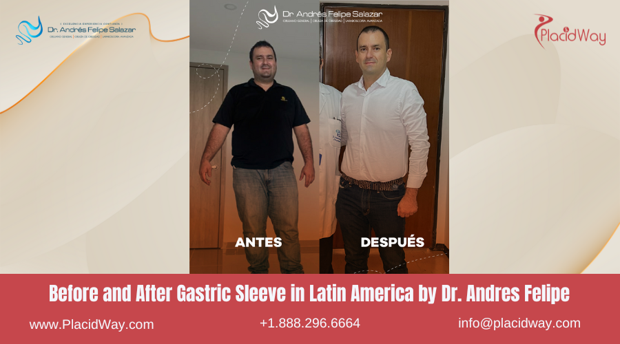 Gastric Sleeve in Latin America Before and After Images - Andres Felipe