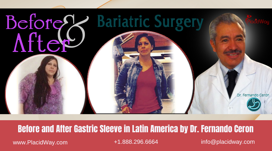 Gastric Sleeve in Latin America Before and After Images - Dr Fernando Ceron